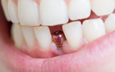 A closeup of a dental implant abutment in a patient’s smile