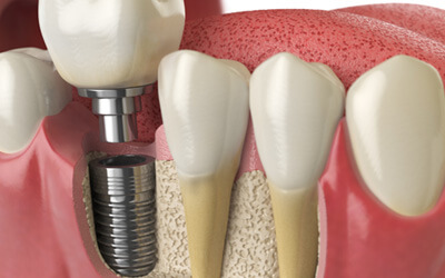 A 3D rendering of a dental implant and its final restoration